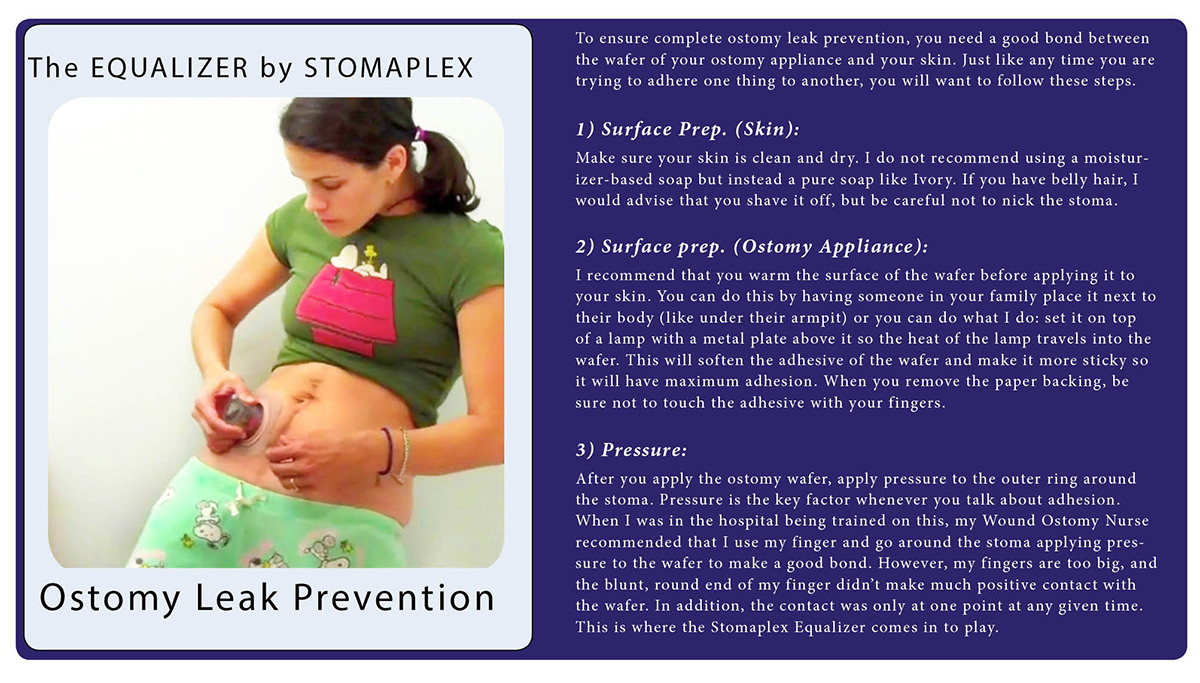 Stomaplex Ostomy Belts and Stomaplex Stoma Guards Stomaplex Ostomy Belt and Stomaplex Stoma Guard.