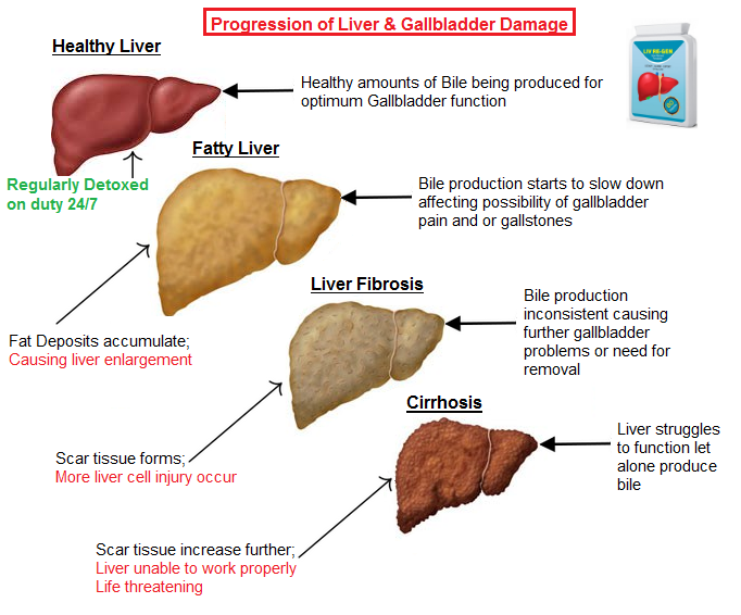 gallbladder-removal.png