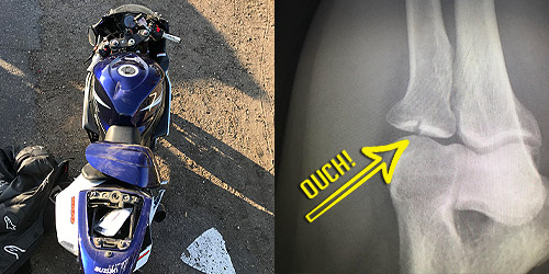 A crashed GSXR 1000 and a Broken Arm