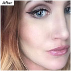 Autumn's Face After Regular Use of Lexli Acne Kit