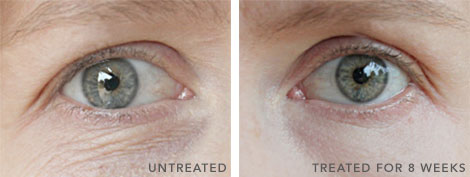 This customer saw remarkable change after using Revital-Eyes for 8 weeks